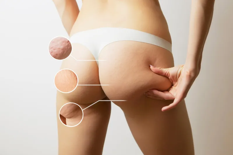 weight loss concept -problem zones of female body