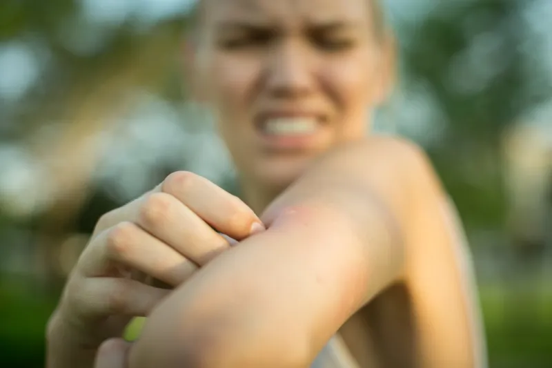 close up of a red mosquito bite on a person's arm, rubbing and scratching it outdoor in the park