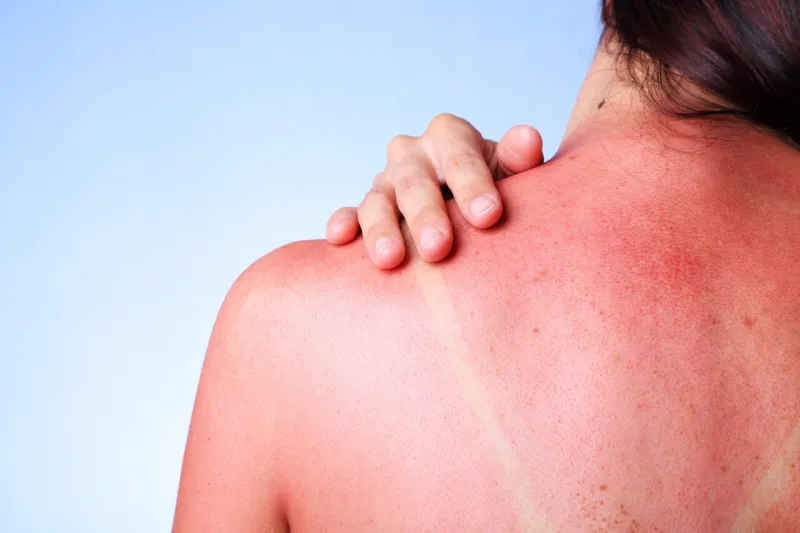 a female touching her sunburned shoulder