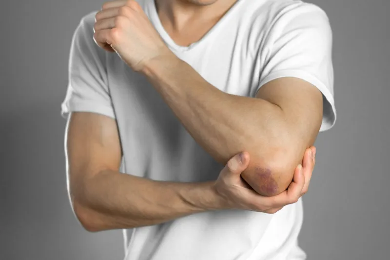 the bruise on the elbow pain in the elbow the man holds his hand close up