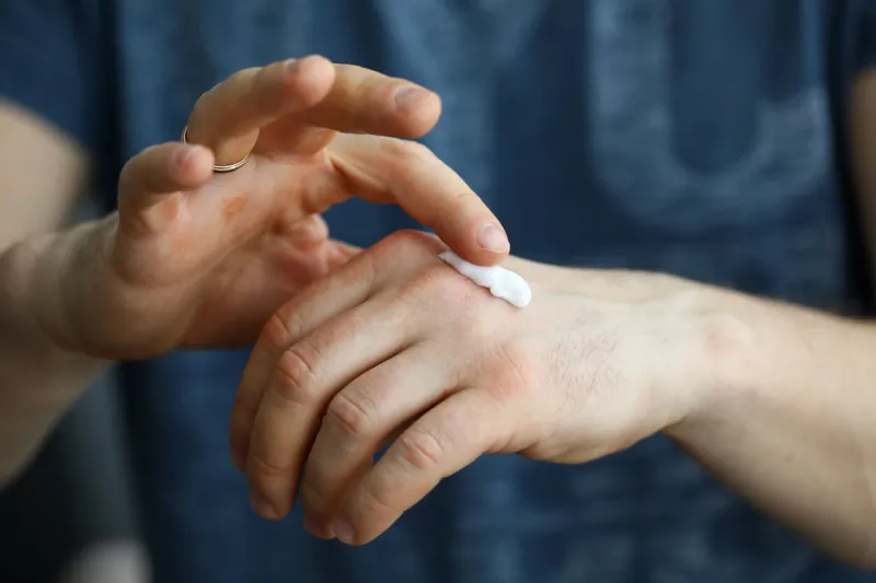 male hands applying moistening cream on skin closeup