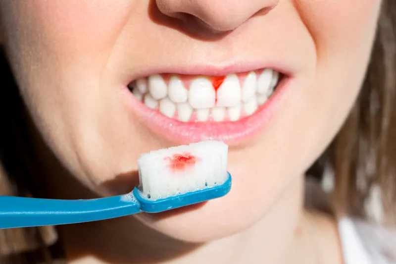 woman with bleeding gums during teeth brushing hard toothbrush problem periodontal disease, avitaminosis, gingivitis, scurvy high quality photo
