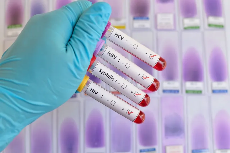 blood sample positive with sexually transmitted diseases  hiv, hbv, hcv, syphilis