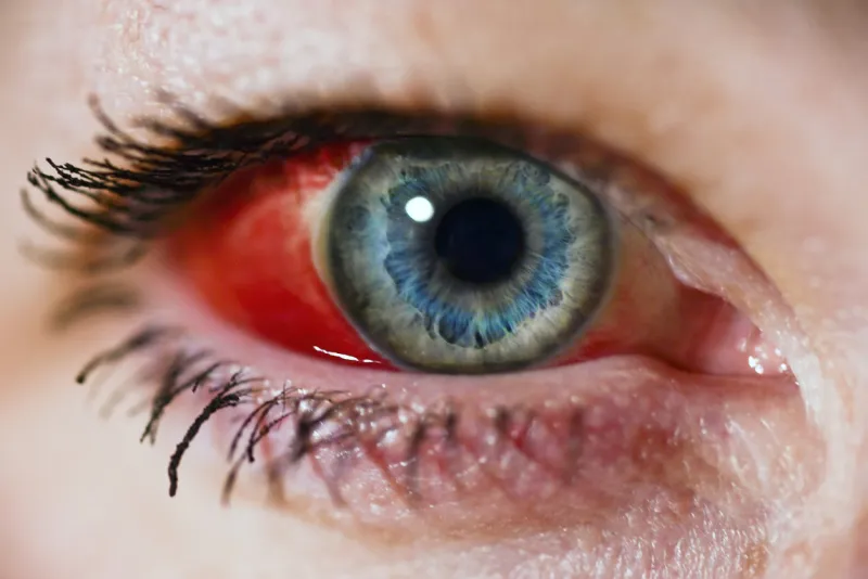 woman's eye with broken blood vessel (subconjunctival hemorrhage)