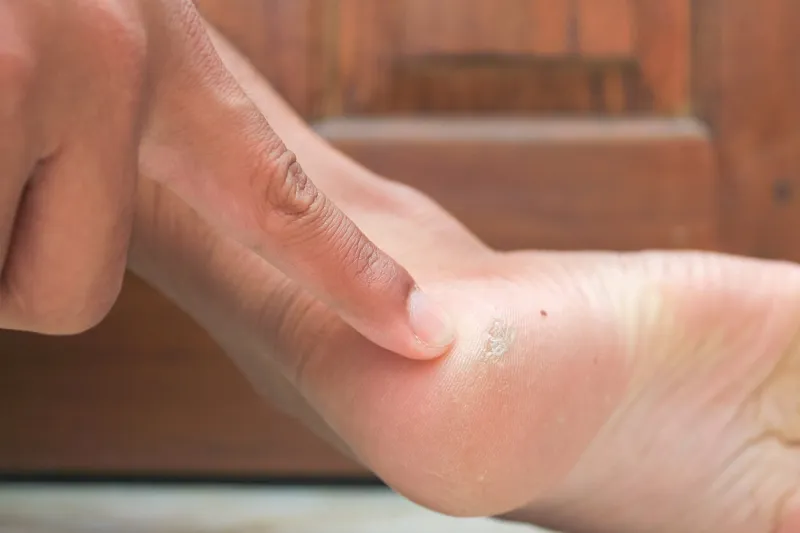 close up hard skin on asian man foot skin problem foot callus or soft corn on the side of man's foot clavus