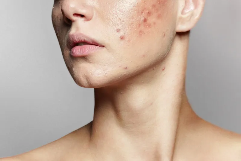 a young woman with bad skin skin with a lot of pimples acne disease, acne treatment