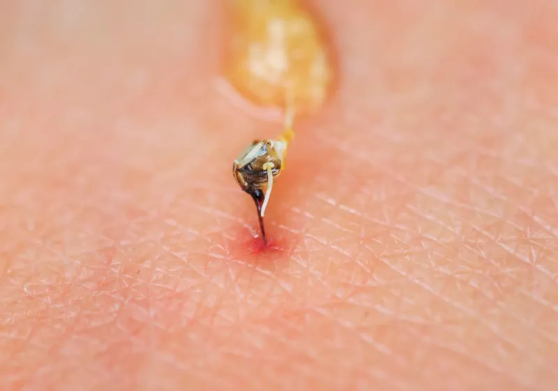 sharp bee sting with a bag of poison broke the skin and left it