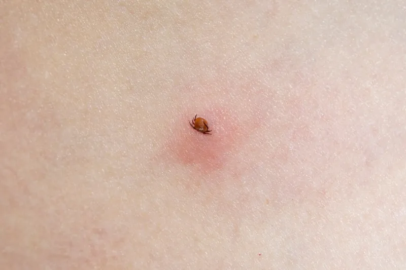 the tick dug into the human body tick with its chelicerae sticking in human skin