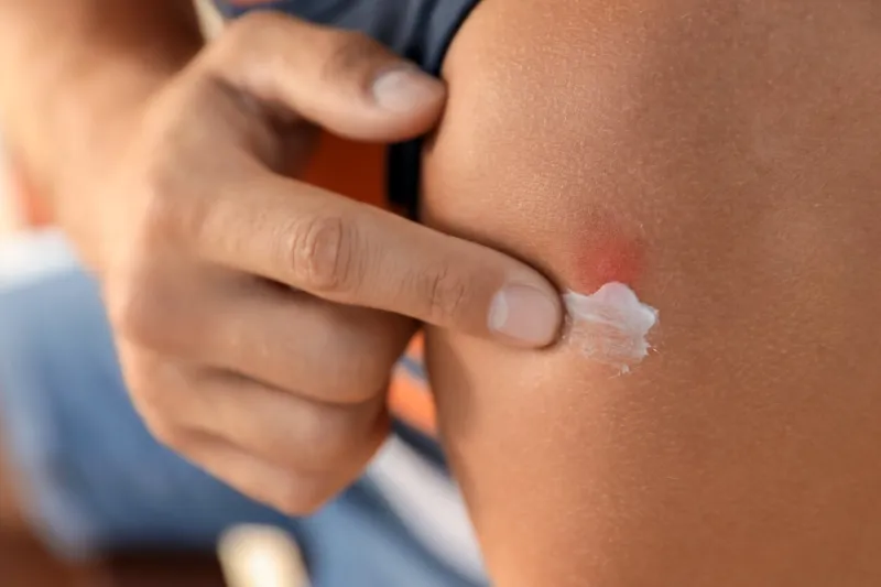 man applying insect repellent cream on his arm outdoors, closeup