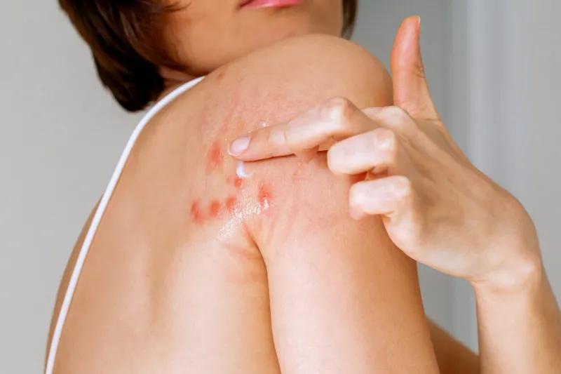 a woman with her shoulder bitten by a bedbug on a white background, close-up skin health problem red pimples