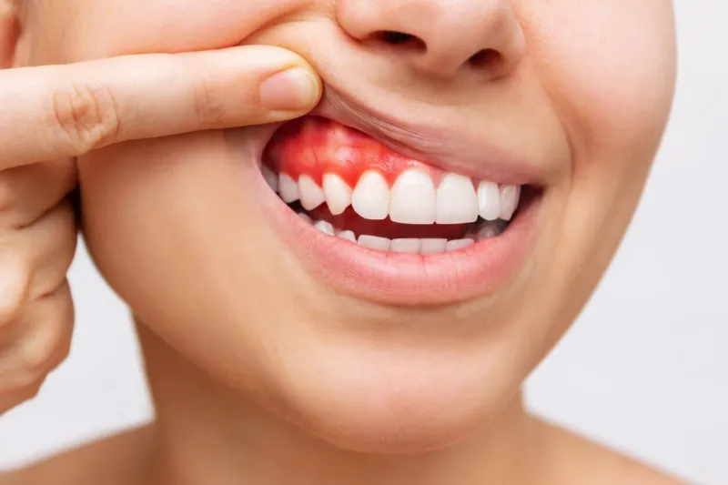 gum inflammation cropped shot of a young woman showing bleeding gums isolated on a white background dentistry, dental care