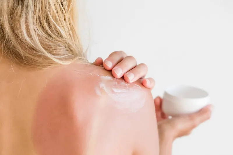 on woman's back skin smears cream after sun burn