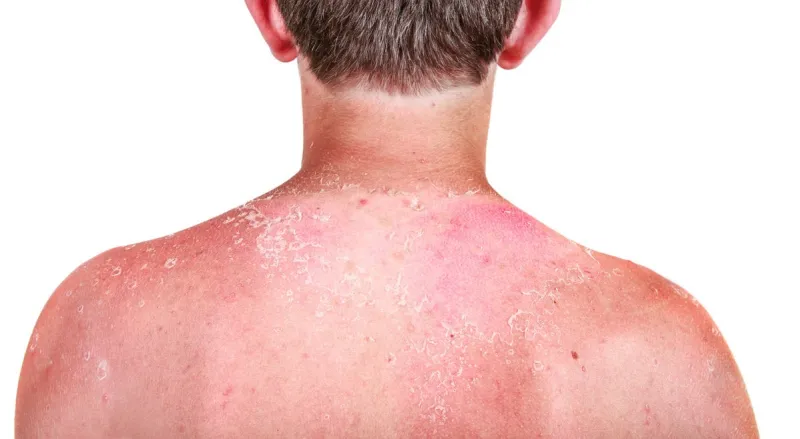 sunburn on a child's back