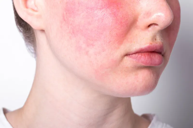 rosacea couperose redness skin, red spots on cheeks, young woman with sensitive skin, patient face close-up