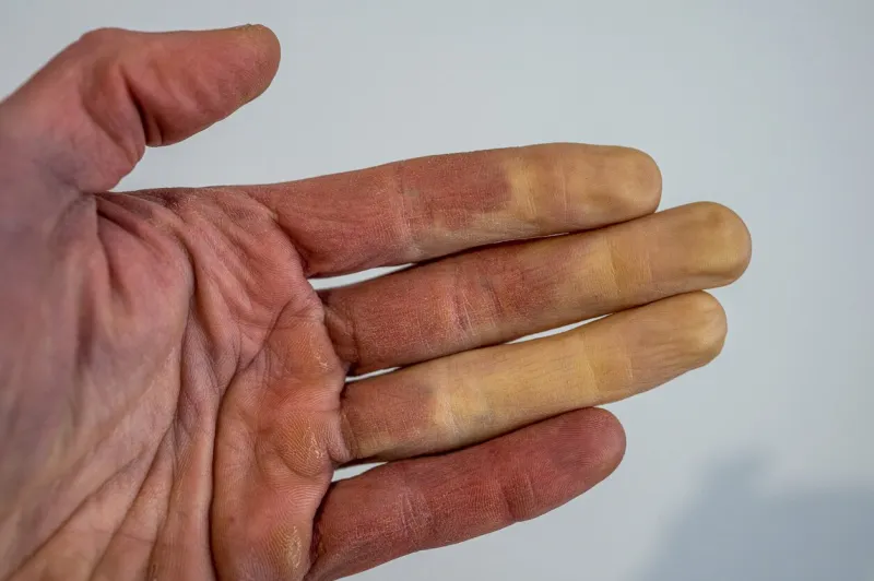 a frostbitten male hand with raynaud's syndrome, raynaud's phenomenon or raynaud's disease
