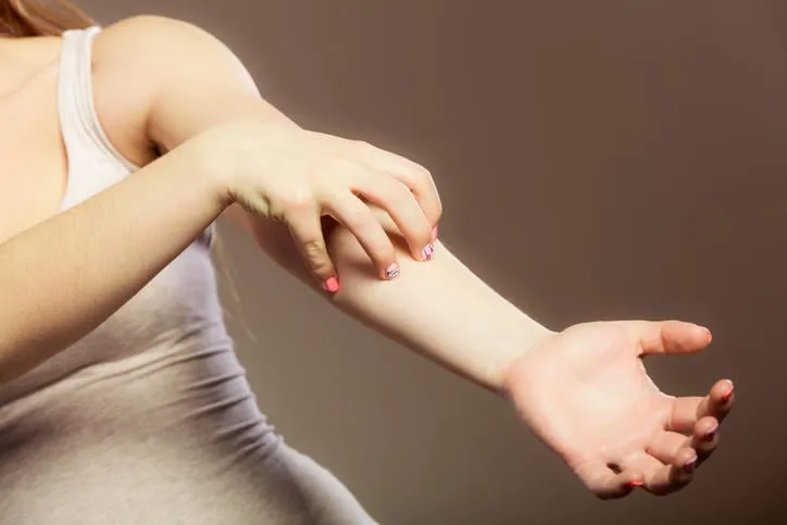 problème de santé jeune femme gratter son bras qui démange avec une éruption cutanée d'allergie