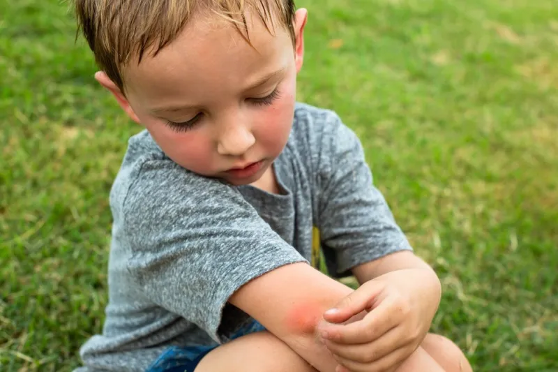 a little boy scratching his arm from a red mosquito bite after playing outdoor in the tropical summer time