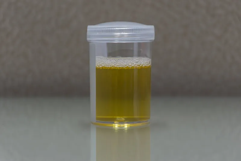 urine sample testing in plastic bottle for examination in laboratory hospital
