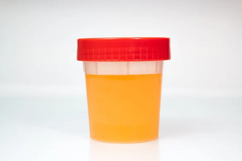 urine sample in closed transparent plastic can