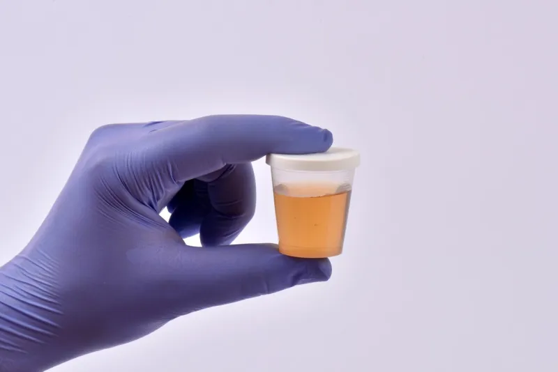 medical urine specimen jar