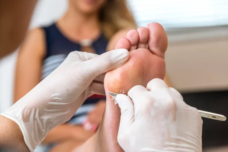 chiropodist removes skin on a wart with a scalpel on the sole of foot of a woman