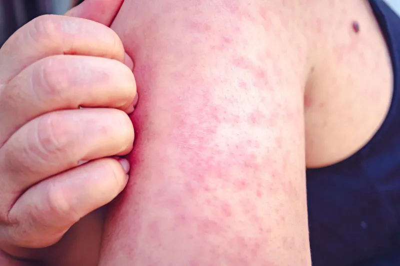 measles, women scratch the upper arm with one hand due to the numerous red pruritus, measles is a disease that can spread easily