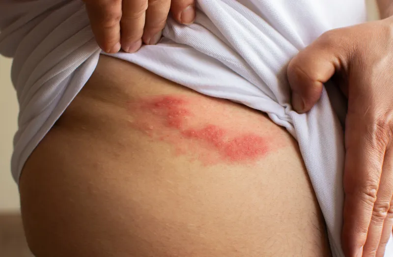 shingles (herpes zoster) blister skin rash