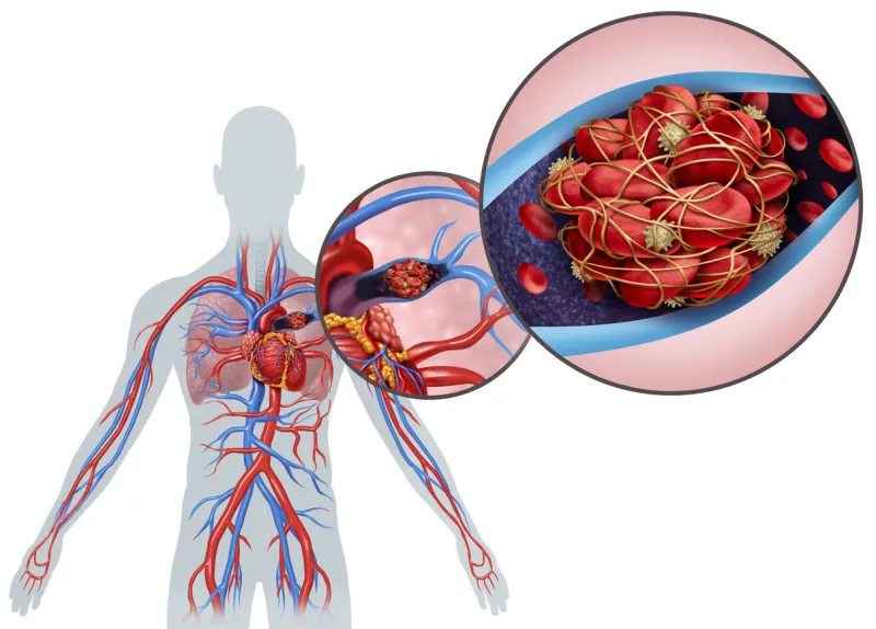 pulmonary embolism with a blood clot as a disease with a blockage of an artery in the lungs with 3d illustration elements