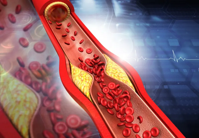 clogged arteries, cholesterol plaque in artery 3d illustration