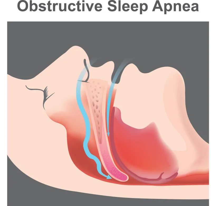 snoring is the vibration of respiratory structures and the resulting sound due to obstructed air movement during breathing while sleeping