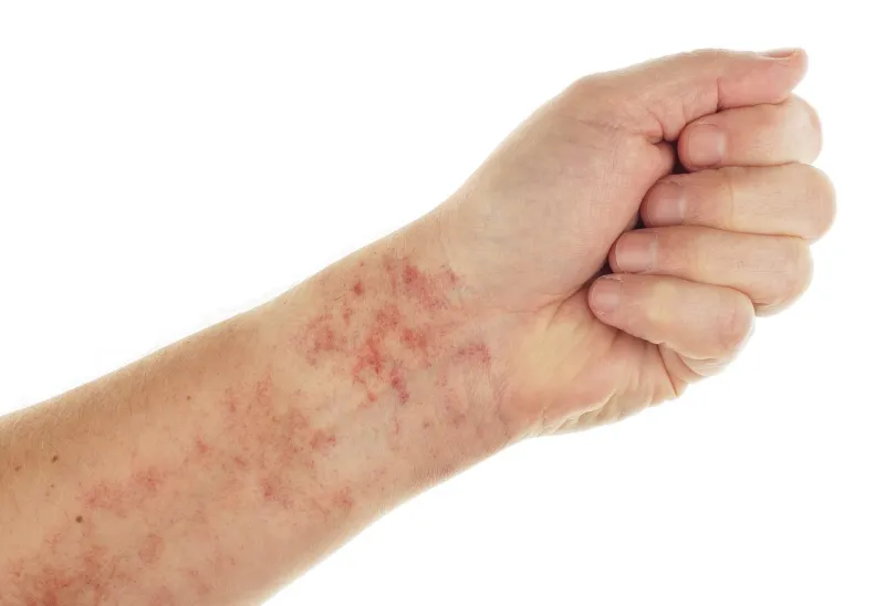 forearm showing capillaritis or leaking capillaries