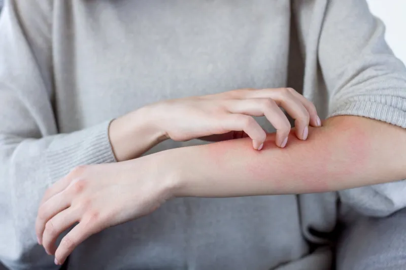 closeup girl is scratching her hand with nails reddened, inflamed body parts causes discomfort and itching young woman is suffering from bouts of allergies dermatological skin diseases concept