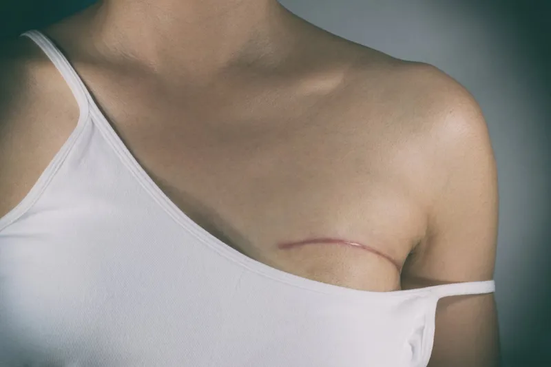 breast cancer surgery scars by partial mastectomy with effect filter