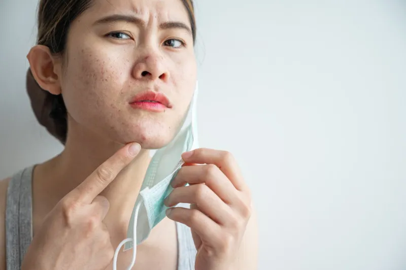 asian woman worry about acne occur on her face after wearing mask for long time during covid-19 pandemic