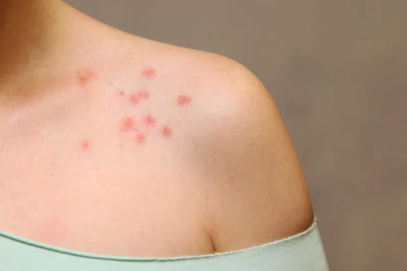 the concept of allergy shoulder with rash on white background