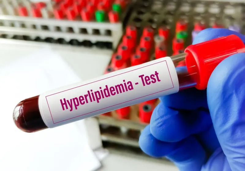 blood sample for hyperlipidemia, dyslipidemia lipid profile hypercholesterolemia