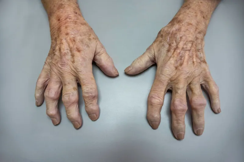 mature patient with a osteoarthritis