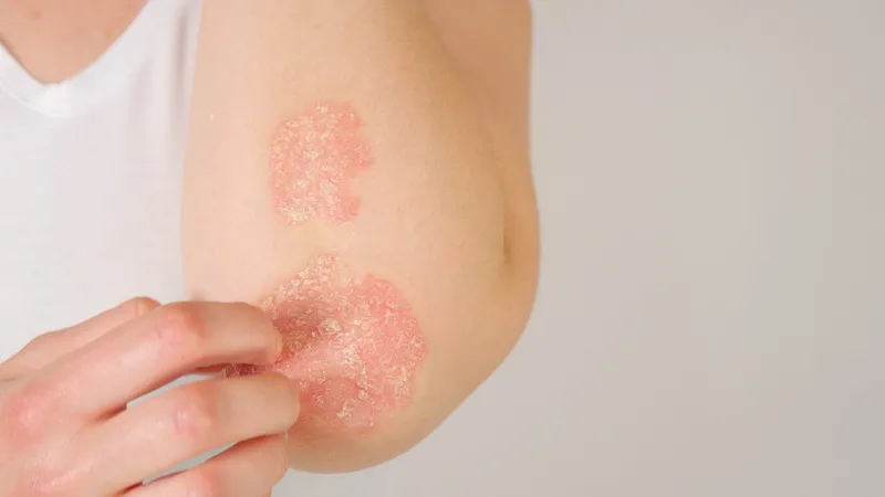 close up  unrecognizable young woman suffering from autoimmune incurable dermatological skin disease called psoriasis female gently scratching red, inflamed, scaly rash on elbows psoriatic arthritis