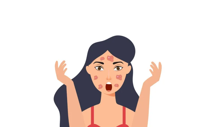 a young girl has skin problems with acne, vitiligo skin and allergic pimples on her face skincare and dermatology concepts flat style vector illustration