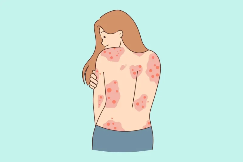 unhealthy woman showing red rash on back suffer from dermatitis unwell girl struggle with dermatology disease healthcare concept vector illustration