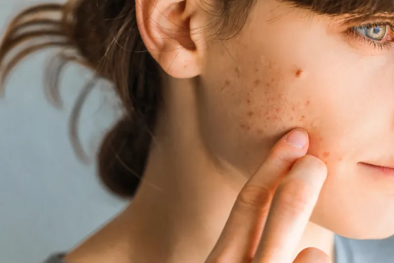 woman with red cheeks- diathesis or allergy symptoms redness an