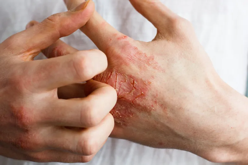the problem with many people - eczema on hand white background man itchind skin