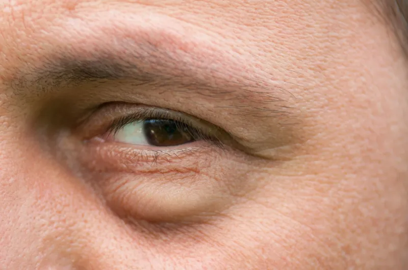 eyesore, inflammation or bag swelling under eye medical problem like conjunctivitis