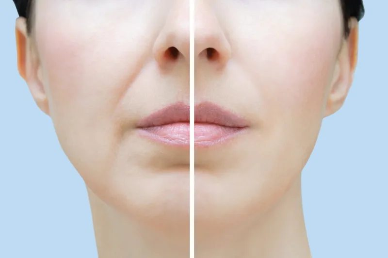 nasolabial folds in a caucasian woman face close up before and after