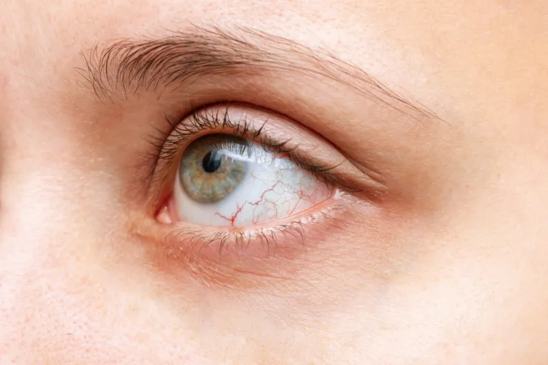 close-up of woman's eye with red inflamed and dilated capillaries hemorrhage under the conjunctiva disease of retina of the eye conjunctivitis, keratitis, dry eye syndrome, trauma, uveitis