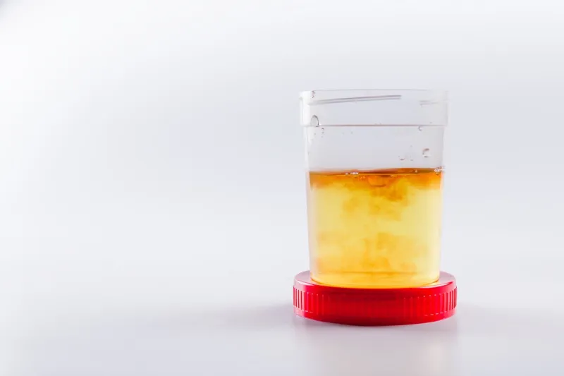 cloudy or bloody urine sample in sterile plastic container on white background with, cloudy or bloody urine