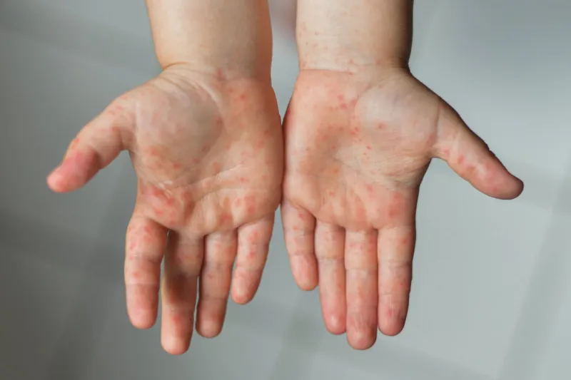 enterovirus legs hands mouth rash on the body of a child cocksackie virus