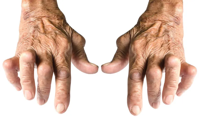 old woman's hands deformed from rheumatoid arthritis isolated on white background