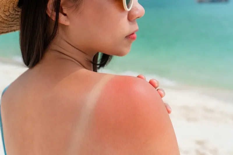 sunburned skin on shoulder of a woman because of not using cream with sunscreen protection red skin sun burn after sunbathing at the beach summer and holiday concept