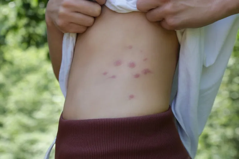 red, swollen and itchy spots on skin caused by insect bites or allergy skin reaction to insect bites